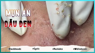 Big Cystic Acne Blackheads Extraction Blackheads amp Milia Whiteheads Removal Pimple Popping [upl. by Sabba]