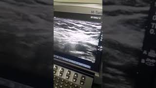 US guided genitofemoral nerve block [upl. by Ahseyi314]