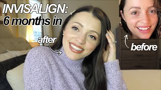 THE TRUTH ABOUT INVISALIGN  Before  After 6 months  FAQ Answered [upl. by Ojillib]