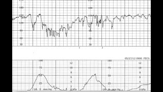 Fetal Monitoring Segment 4 Fetal Heart Decelerations [upl. by Mercer]