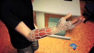 Tech Report  Osteoid 3D Printed Cast [upl. by Nesnar149]