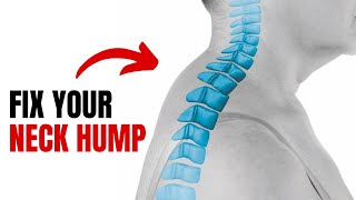 Fix Your Neck Hump At Home With FULL ROUTINE [upl. by Hamitaf]