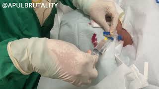 Right internal jugular central venous catheter CVC  CV line  vena dalam [upl. by Leima]