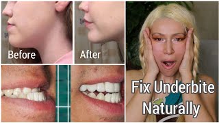 How To Fix An Underbite Naturally  Correcting Protruding Jaw and Chin  Jaw Exercises [upl. by Vanhook]