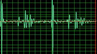 Minor Cardiomyopathy slow [upl. by Beisel]