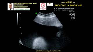 Amelia  Phocomelia syndrome [upl. by Imoan222]