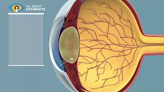 What is a Cataract  Cataract surgery video [upl. by Tingey45]