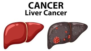 LIVER CANCER BSC NURSINGdailypost [upl. by Aelyak]