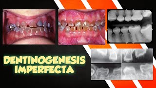 Ameloblastoma  pathogenesis clinical features radiographic feature differential diagnosis [upl. by Anirtak]