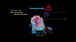 SmartNEasy Cardio  Tamponnade  Dr Astuce [upl. by Presley]