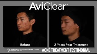 AviClear Acne Treatment Patient Testimonial [upl. by Atiuqet]