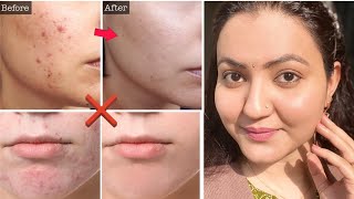 मुश्किल से मुश्किल मुंहासे PIMPLES ACTIVE ACNE Dark Spots का करें 100 इलाज और पाएं बेदाग Skin [upl. by Nylinnej844]