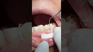 Zirconia bridge dentist [upl. by Ajnos]