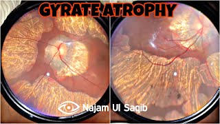 Retinochoroidal Gyrate Atrophy With Myopia [upl. by Eniamzaj]