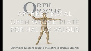 Arthrex Basal osteotomy for Hallux valgus [upl. by Ranilopa168]