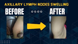 Case of Axillary lymph nodes swelling [upl. by Selle]