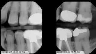 Tips and Tricks for Bitewing XRays [upl. by Thomasa99]