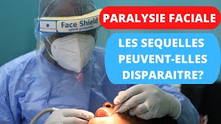 Paralysie faciale de Charles Bell Les séquelles peuventelles disparaître après traitement [upl. by Nwadal]