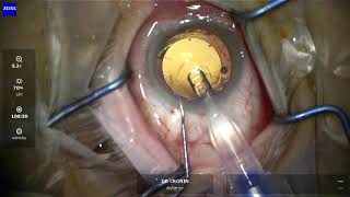 Secondary sulcus intraocular lens surgery explained for patients [upl. by Acirret]