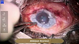 Optical penetrating keratoplasty in Xeroderma Pigmentosum [upl. by Dagny]