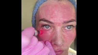 Microneedling Technique  Under Eye [upl. by Nelson]