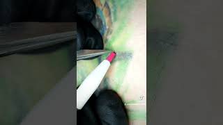 electrolysis hair removal [upl. by Hines730]