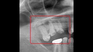 Periapically infected broken up maxillary molar extraction [upl. by Nived]