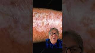 Hypopigmentation and Scar Formation after Laser Tattoo Removal tattooremoval [upl. by Fonzie]