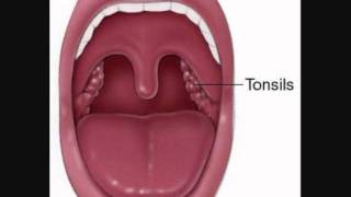 How to Identify and Treat Appendicitis Naturally and avoid surgery [upl. by Ethbin]