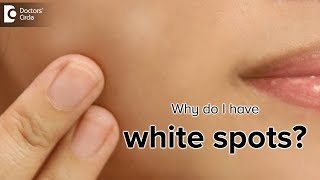 What is the cause of white spots on the skin  Dr Rasya Dixit [upl. by Yleek]