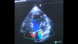 Mitral regurgitation with Lv dysfunction and atrial fibrillation [upl. by Latoniah]