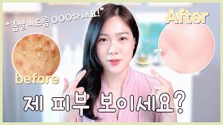 ENG좁쌀여드름 없애는 방법🧖‍♀️ 꿀tip 대방출  생기는 원인 100완전박멸 루틴 [upl. by Nylegna]