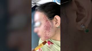 chemical peel treatment for acne  Pimples Treatment  Skinaa Clinic viral skinaaclinic shorts [upl. by Nnairol319]