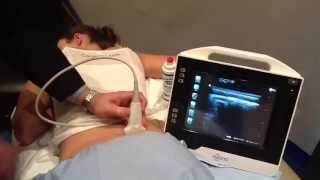 Ultrasound Guided SI Joint Injection  How To [upl. by Lartnom279]