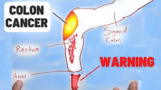 4 Warning Signs of Colon Cancer You Should NEVER Ignore [upl. by Gardie]