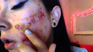 Severe cystic acne accutane week 1 [upl. by Boles]