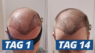 1  14 Tage nach Haartransplantation Der komplette Heilungsverlauf [upl. by Namhar]