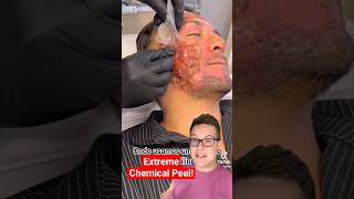 SHOCKING CHEMICAL PEEL  Phenol Peel Results shorts [upl. by Aretse]