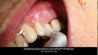 Periodontal pocket treatment with LiteTouch™ ErYAG laser [upl. by Oina]