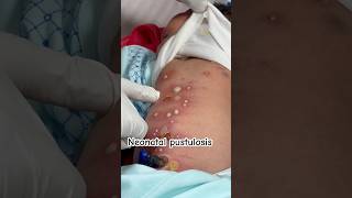 Neonatal pustulosis newborn day 5 skin infection ankur maitrika hospital jammu [upl. by Enyalaj531]