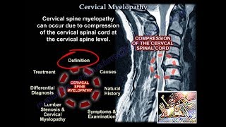 Cervical Myelopathy  Everything You Need To Know  Dr Nabil Ebraheim [upl. by Ynttirb]