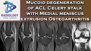 Mucoid degeneration of ACL Celery stalk with Medial meniscus extrusion Osteoarthritis [upl. by Georgy]