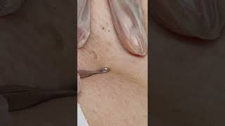 Effective Ingrown Hair Removal  Watch the Transformation [upl. by Kramlich544]