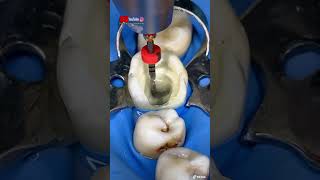 “Tratamiento de conducto en una muela ENDODONCIA” [upl. by Assenay913]