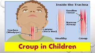 Croup in Children [upl. by Sidwell]