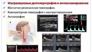 Каротидная эндартерэктомия показания этапы и варианты операции виды пластики сонных артерий [upl. by Egief]