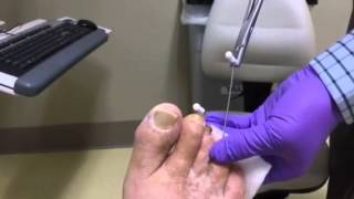 Hammertoe Pin Removal [upl. by Mitchel115]