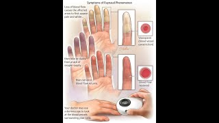 Understanding Raynaud’s Phenomenon  YOU MUST KNOW  DONT FORGET TO SUBSCRIBE THIS CHANNEL [upl. by Bresee288]