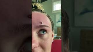 Cystic Acne Extractions Whiteheads  Blackheads Removal Today [upl. by Aselehc]