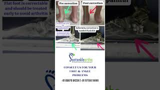 FOOT DEFORMATION CORRECTION footproblem deformationoffoot footandanklesurgeon footcondition [upl. by Jarnagin]